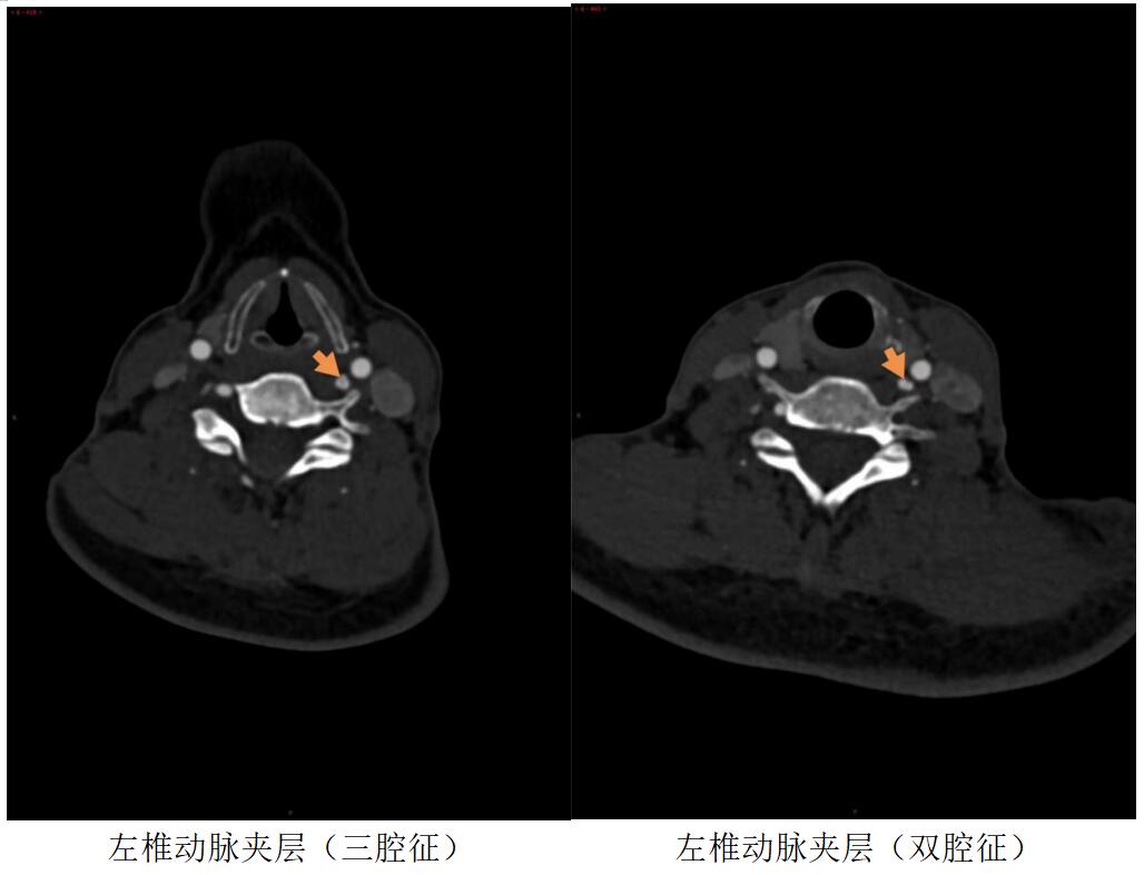 自行頸部按摩圖放松,，誰知卻發(fā)生腦中風(fēng)