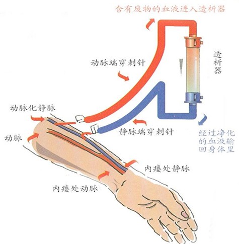 如何正確認識血液透析