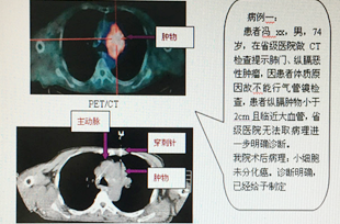 廣西民族醫(yī)院腫瘤科完成兩例臨近大血管的縱膈/肺門(mén)小腫物穿刺活檢術(shù)