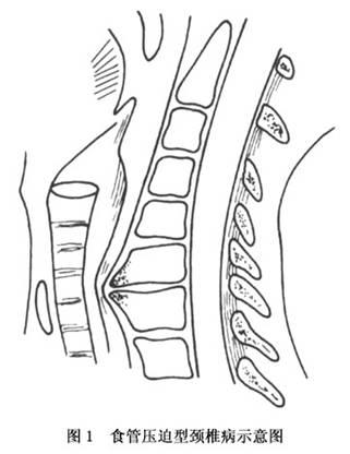 吞咽困難竟是頸椎??？