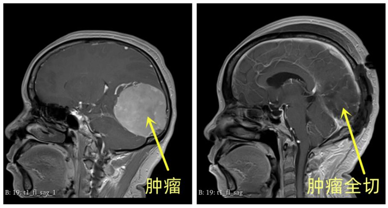 顯微手術顯神威，復雜巨大腦腫瘤被成功切除