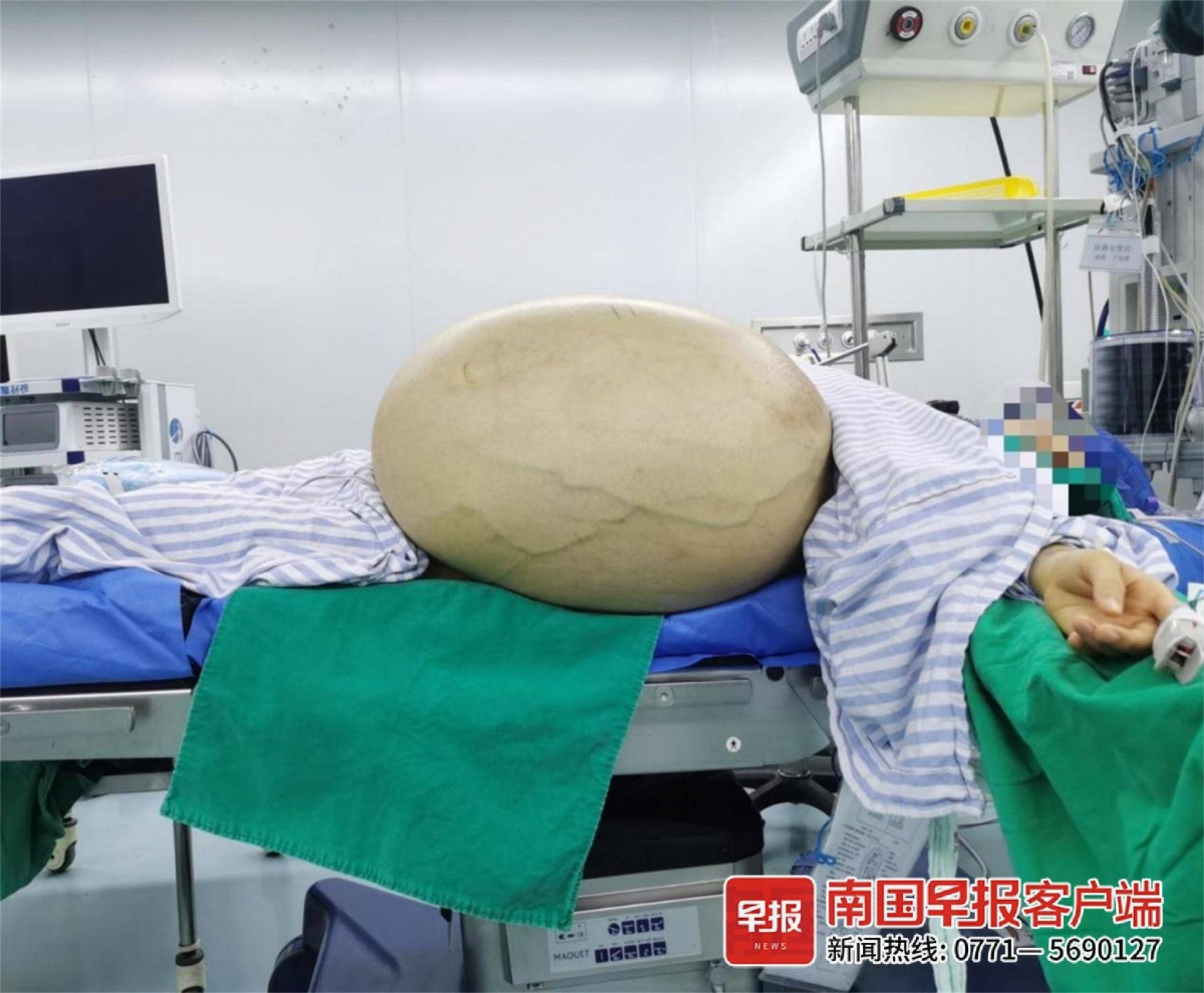 34岁女子长出40公斤卵巢肿瘤,比自身体重还要重-广西新闻网