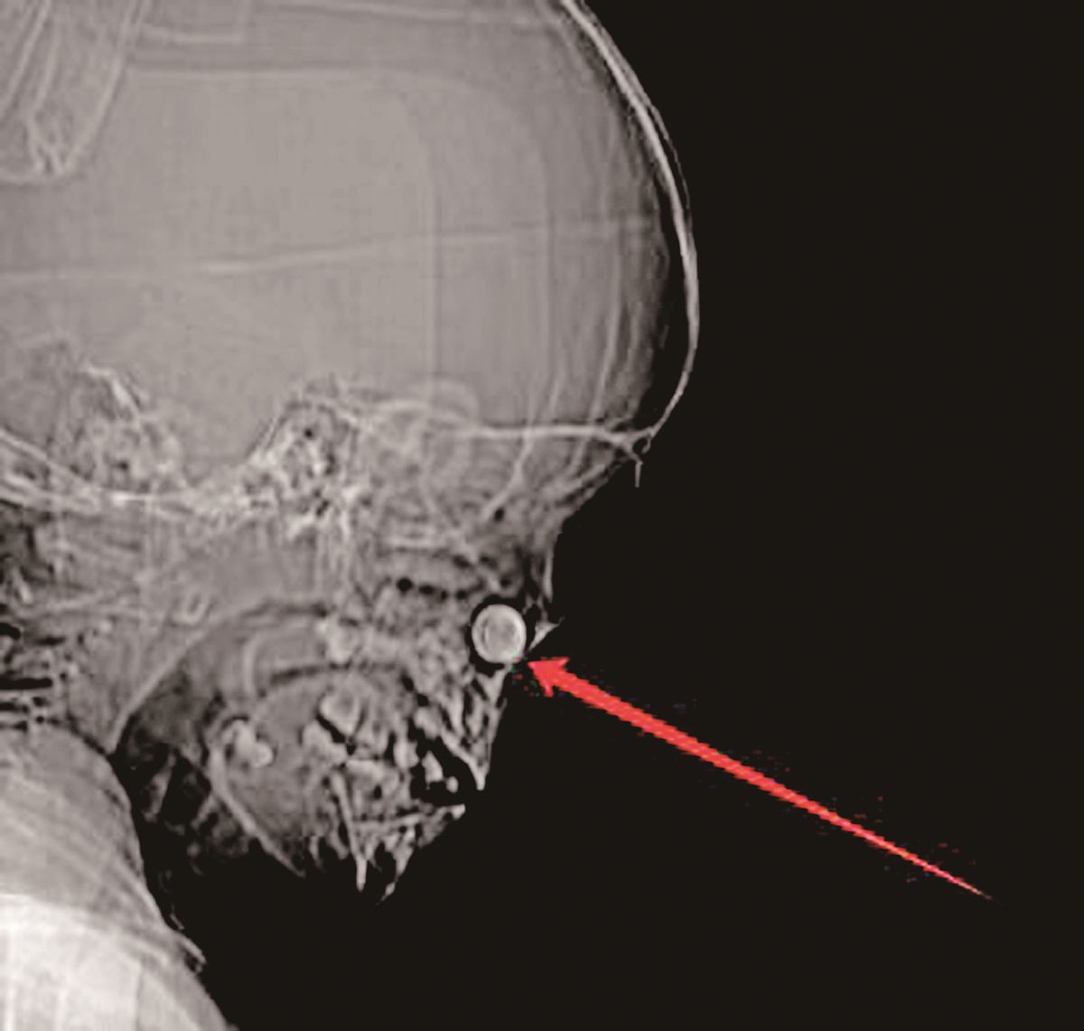 ct影像图显示,患儿鼻腔内有一圆形异物.