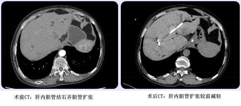 不開腹也能取石,！我院消化內(nèi)科二區(qū)成功實施ERCP+膽胰子鏡聯(lián)合手術(shù)