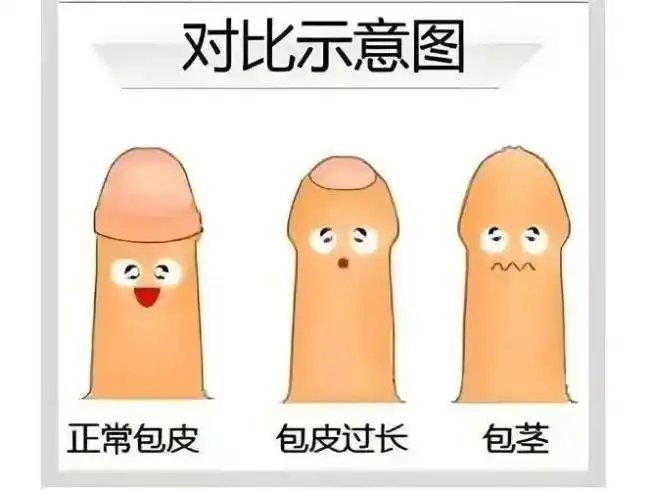 套扎环怎么下健康小喇叭｜暑假“割包皮”扎堆？医生提醒：这些情况才需“动刀”_https://www.jmylbn.com_新闻资讯_第1张