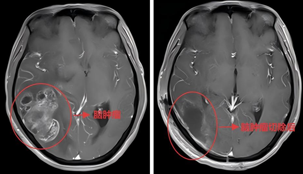 再闯“生命禁区”！爱游戏意甲亚洲赞助商神经外科成功实施高难度二次手术切除复发脑瘤