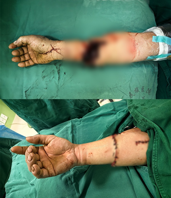 5小时生死博弈！我院骨科成功救治一例前臂离断伴严重创伤休克患者
